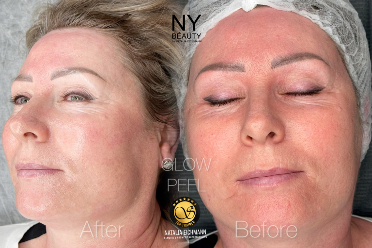 Tiefe Reinigung Gesichtsbehandlung in Saarland Gesichtsreinigung in Quierschied in Saarland