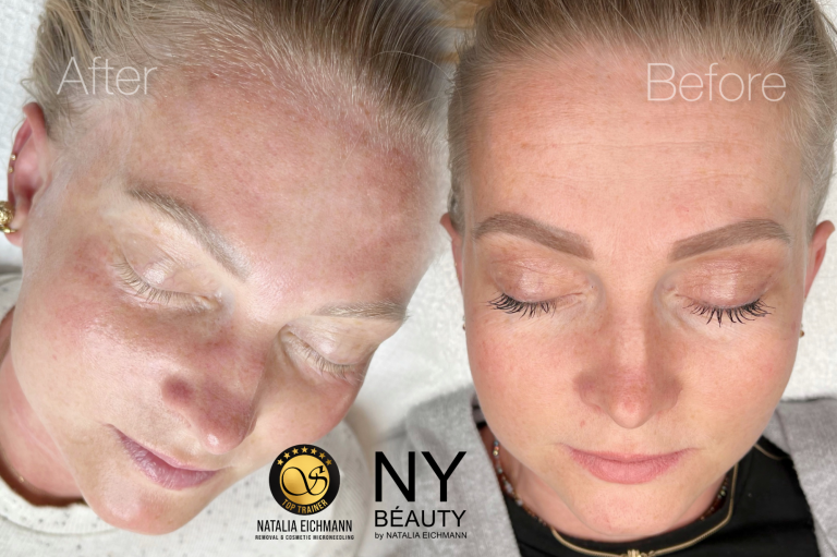 Microneedling Behandlung in Saarbrücken Microneedling Behandlung