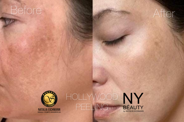 Carbon Peeling gegen Pigmentflecken Carbon Peeling Hollywood Peeling in Saarbrücken