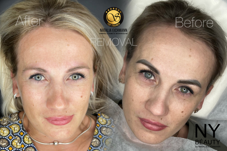 Remover Entfernung Permanent Make-UP Entfernung Tattoo Removal